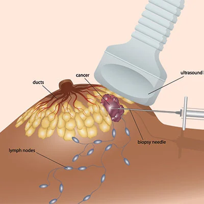 Core Biopsy: Μια Σημαντική Διαγνωστική Μέθοδος για τον Μαστό